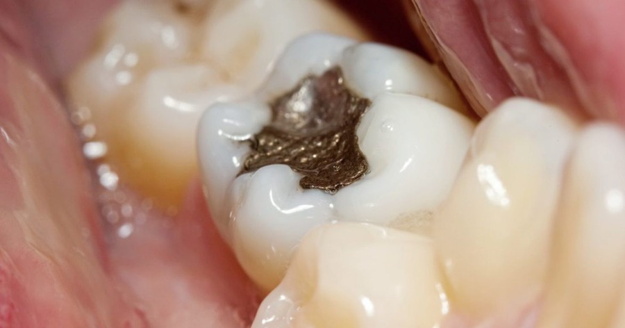 Ask the dentist: Filling the gap safer than ever as amalgam fillings phased out