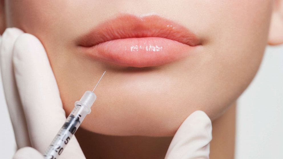 Botox users getting younger after a year of Zoom meetings, doctors say
