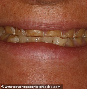 Fizzy, fruity mixers with alcohol can be catastrophic for teeth. This woman, 47, was left with very severe erosion