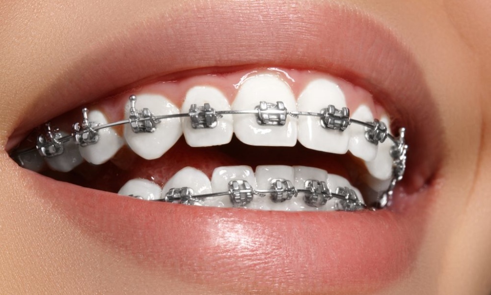 Invisalign provides more comfort and ease than the conventional dental braces