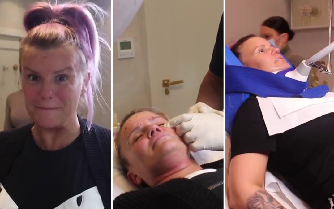 Kerry Katona gets a ‘brand new face’ as she shows off painful procedure to remove fat from her chin and gets Botox