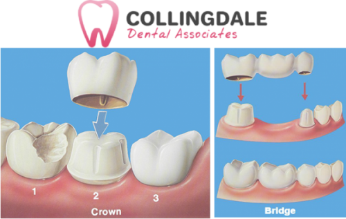 Dental Crowns/Bridges Collingdale Update For Those Needing Cosmetic Dentistry