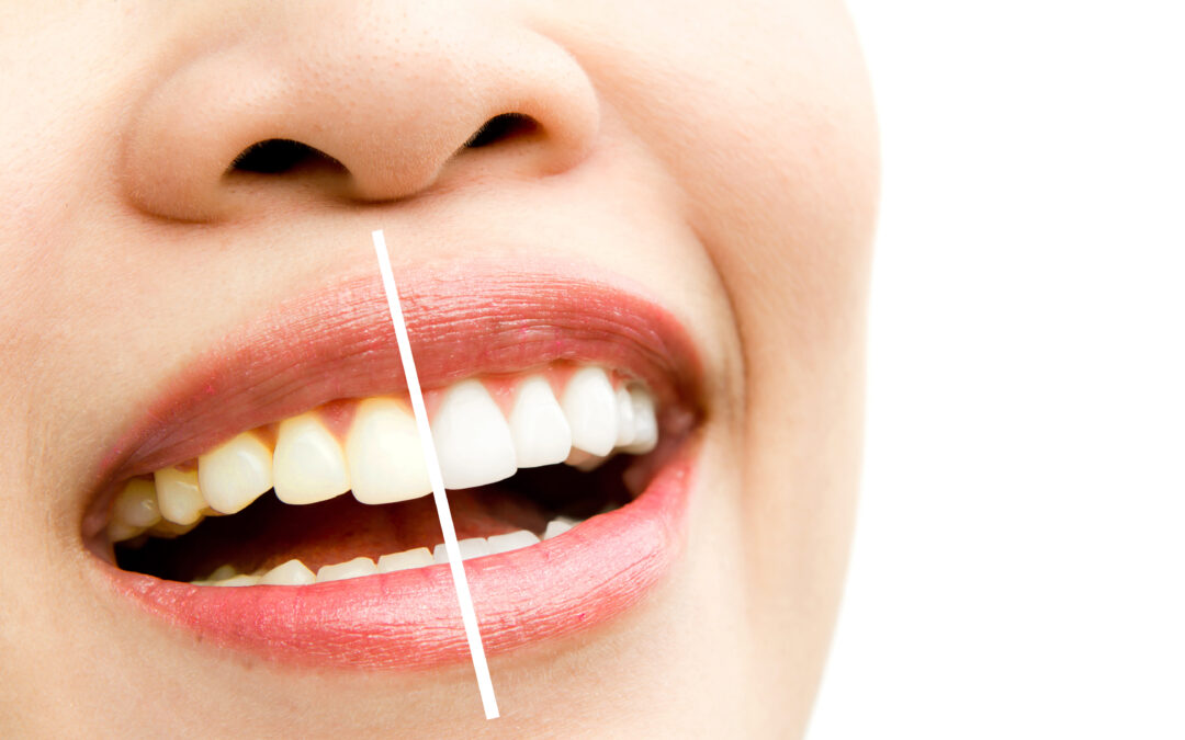 Is Smile Makeover Really Beneficial?