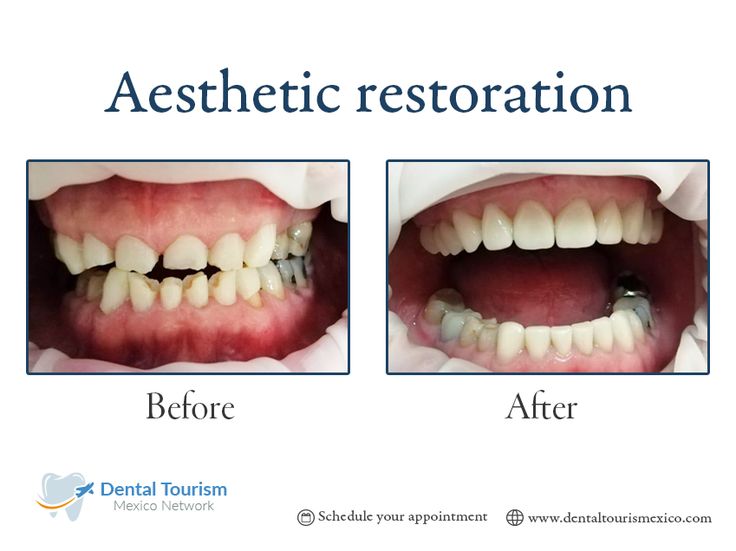 Restore your Smile in Mexico Dental tourism, Dental