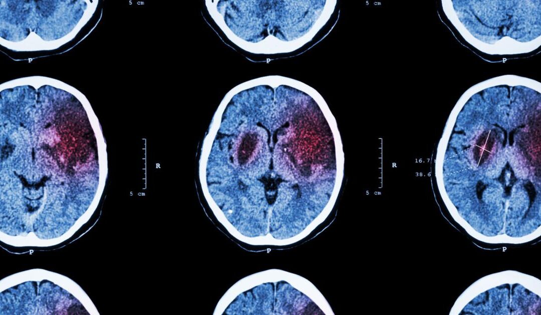These 3 things this doctor learned from his stroke could save your life | Lifestyle