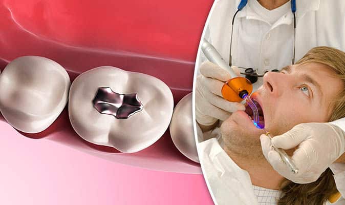 Lifelong tooth fillings now a possibility, new technique repairs teeth and kills bacteria