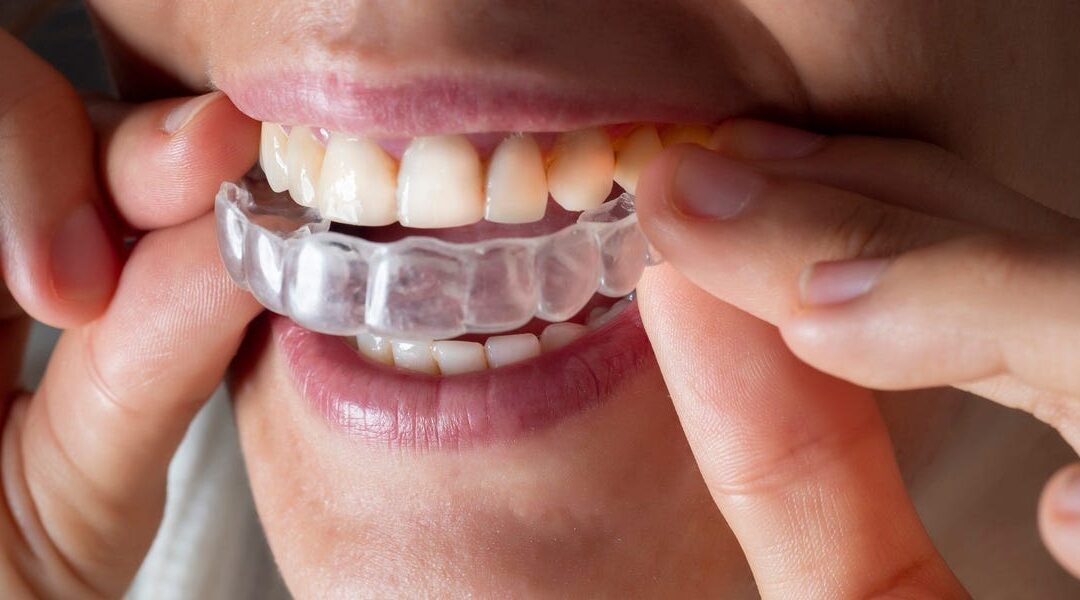 Invisalign Vs. Braces: Cost, Effectiveness, and Appearance