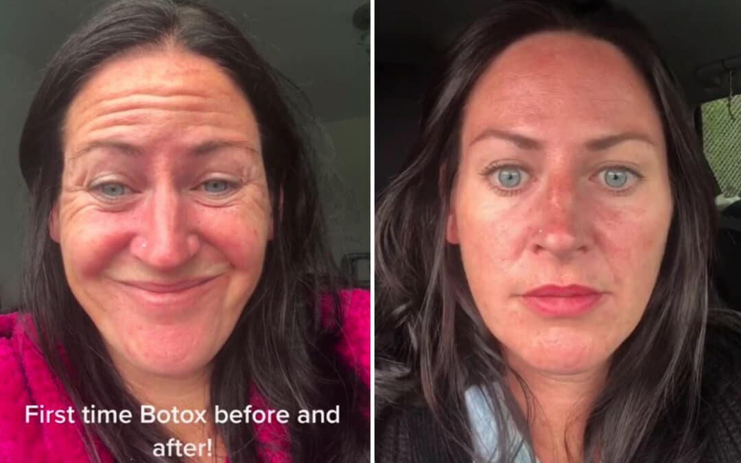 Woman gets Botox for the first time and looks so different people don’t think it’s the same person