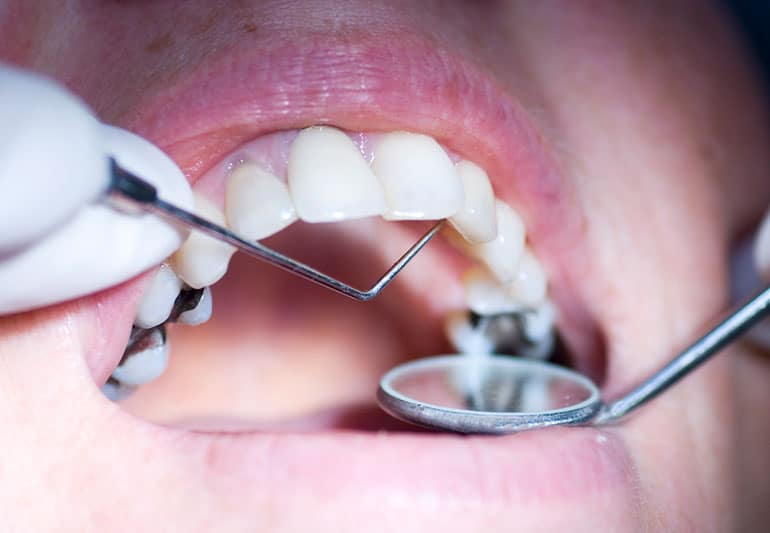 Is There Mercury in Silver Dental Fillings? – Cleveland Clinic