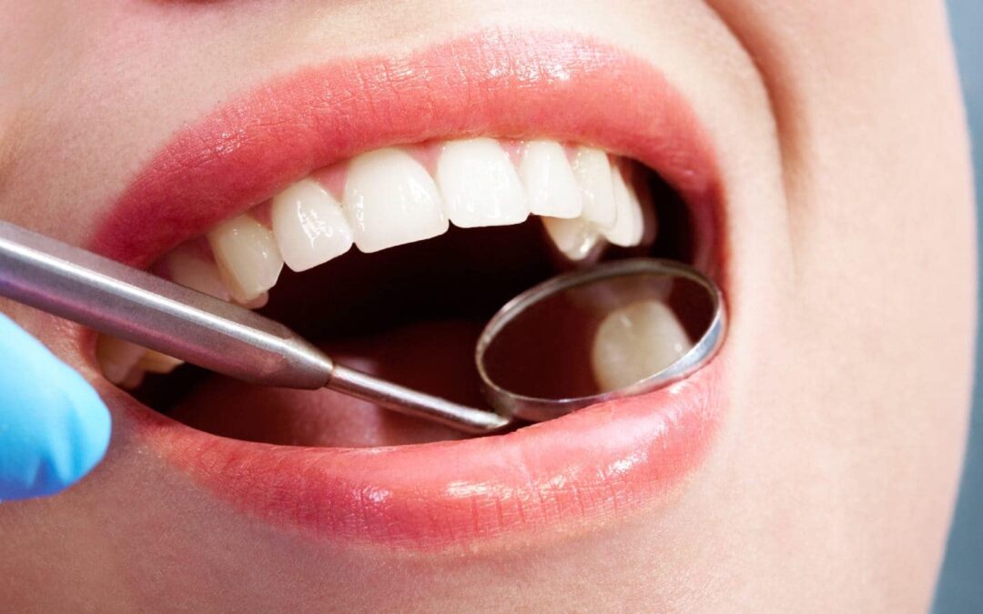 Do all your tooth cavities require dental fillings? An expert answers