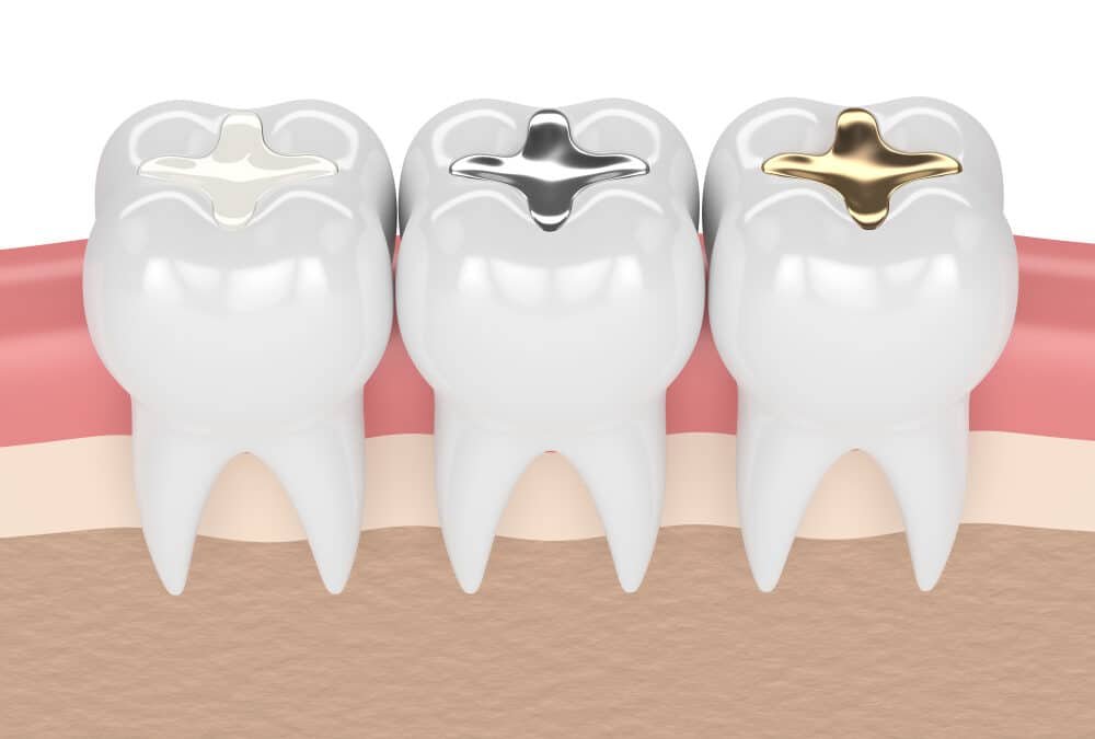 4 Benefits of White Tooth Fillings