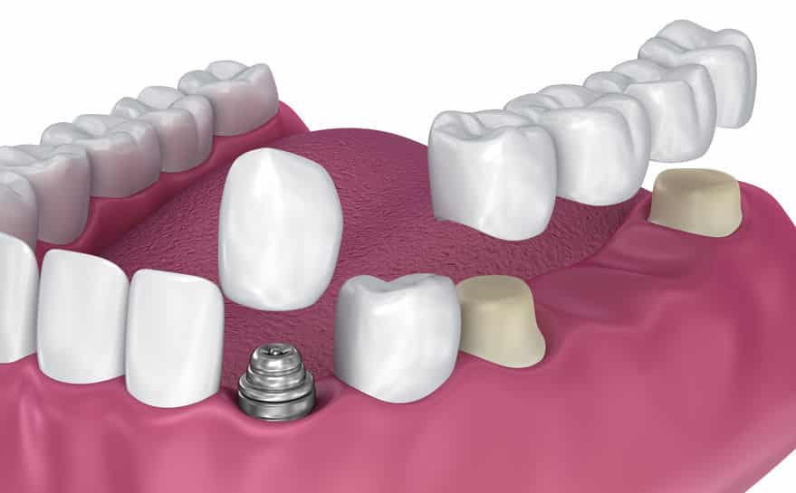 Caring for Your Dental Crowns: The Ultimate Guide!
