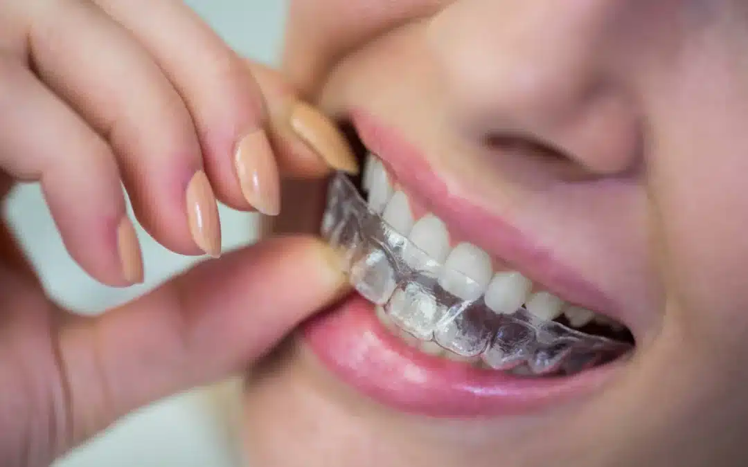 Invisalign NJ | How Much The Cost