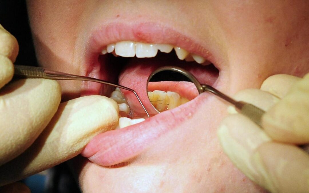 Dozens of admissions for tooth extractions on children in Nottinghamshire