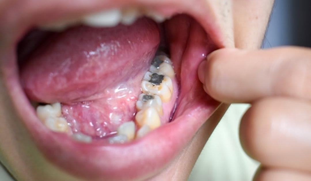 Study: Use of dental amalgam in fillings decreases 73% in 5 years