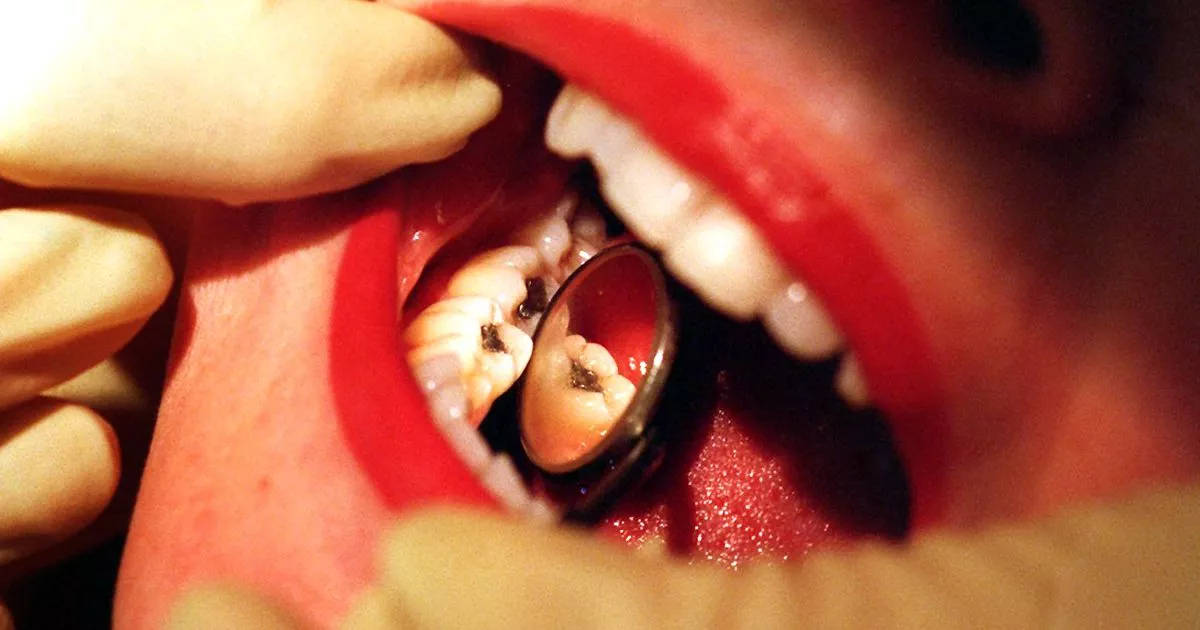 More than eight fillings could raise your risk of brain, heart and kidney disease