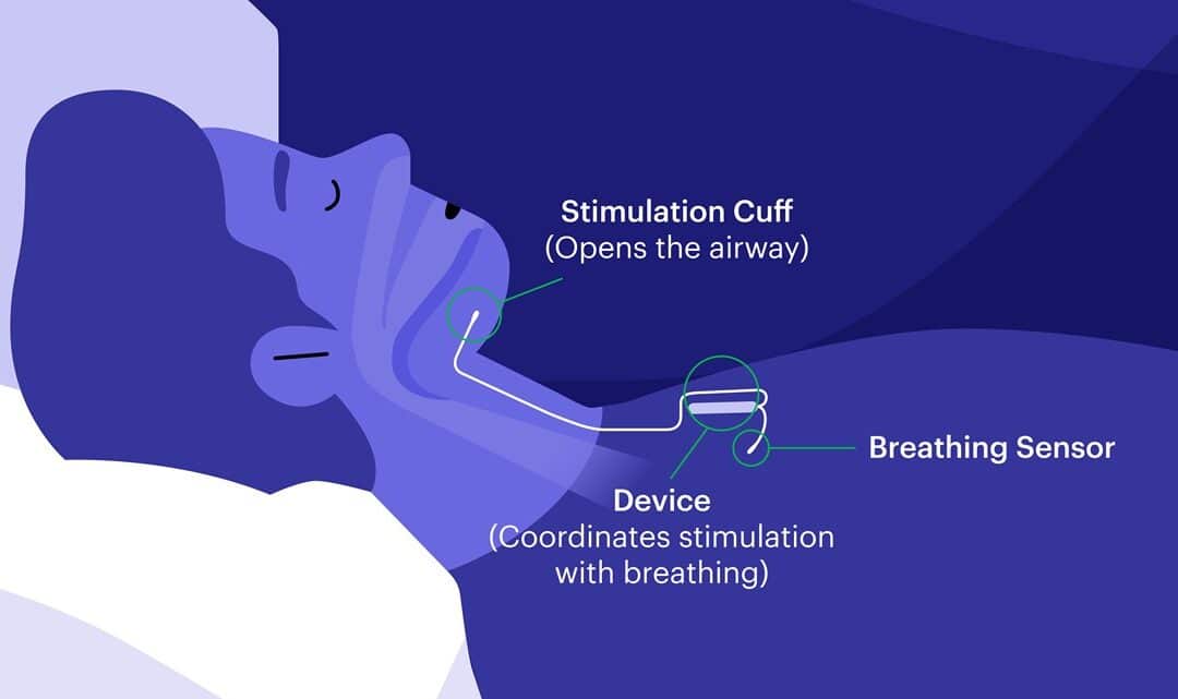 Lesser-known surgery eliminates Northern California woman's apnea