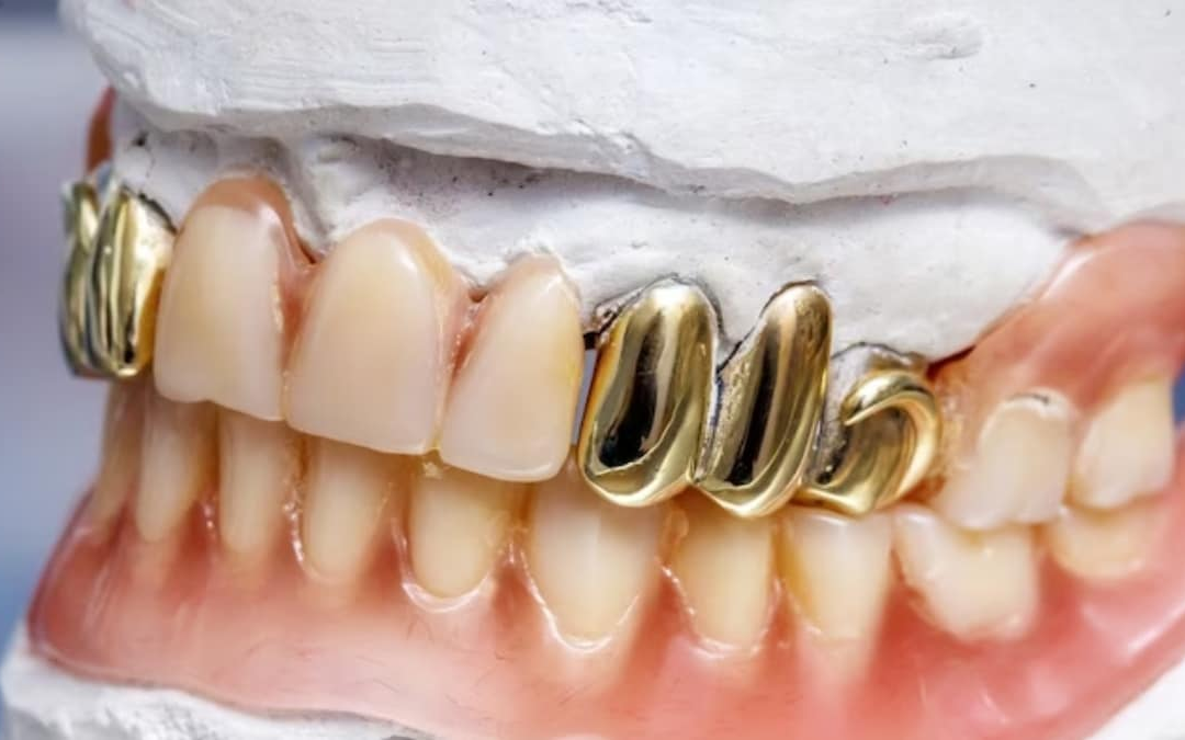 Why Pure Gold Isn't Ideal For Dental Crowns; Dentists Respond