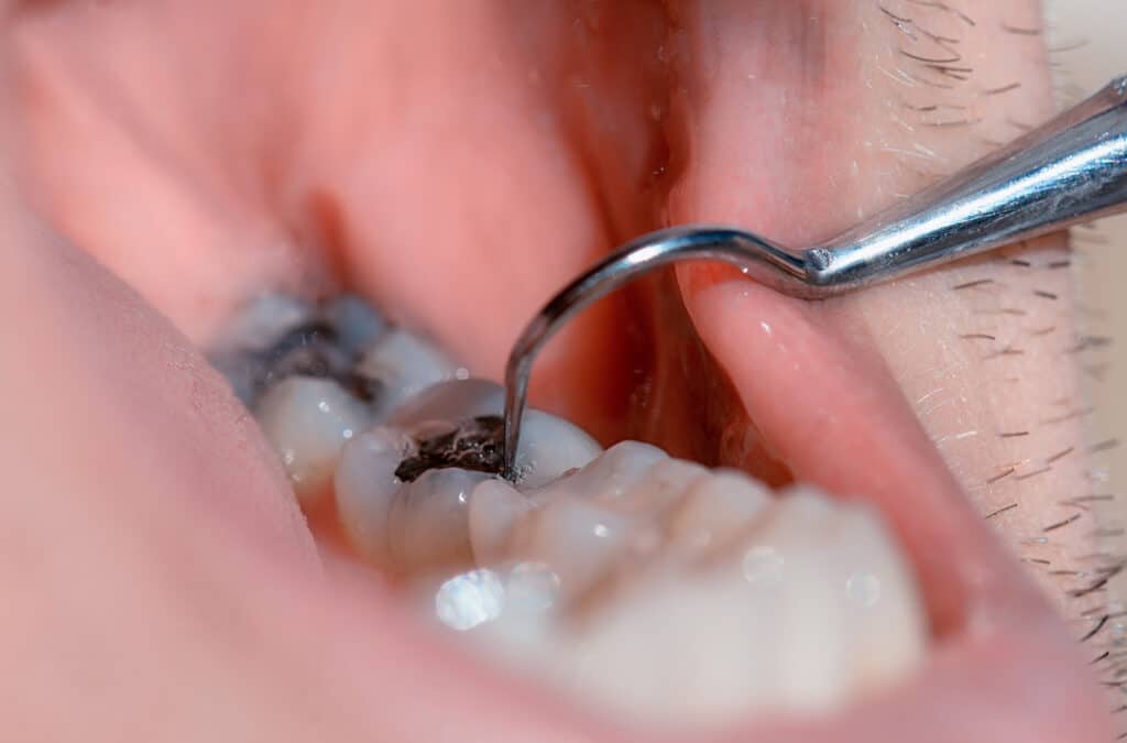 Use of dental amalgam in fillings decreases significantly in five years