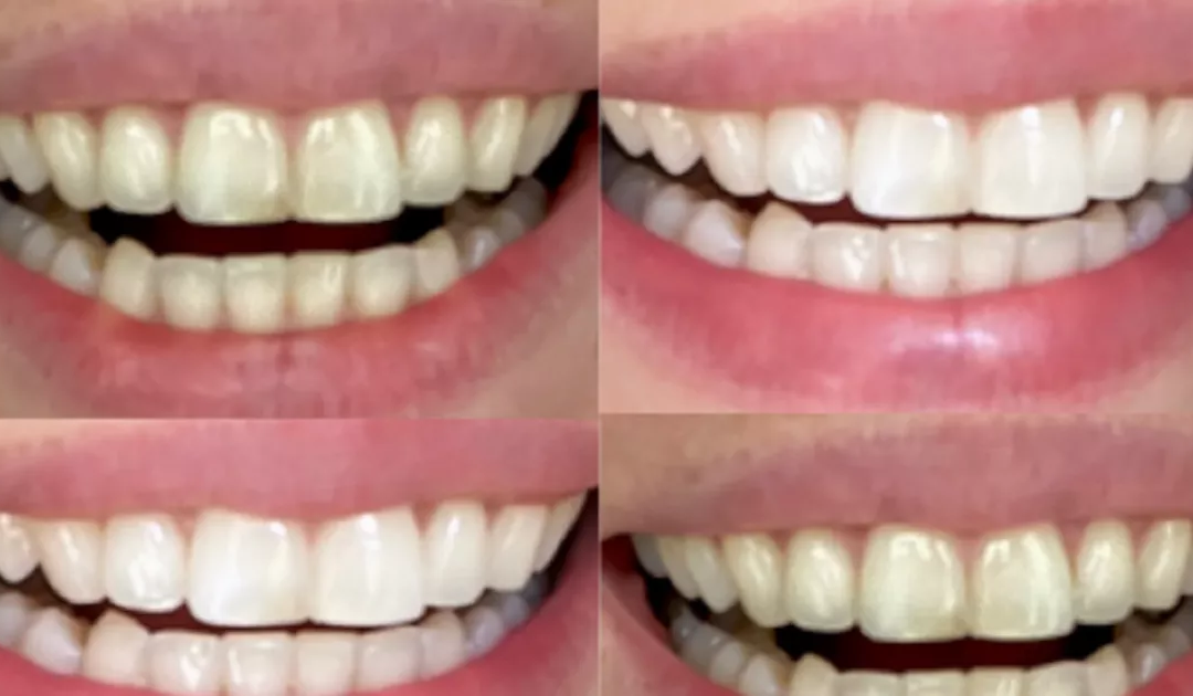 Shoppers ‘can’t stop using’ dentist-permitted £21 teeth whitening solution claimed to ‘erase tea and espresso stains with no harming enamel’