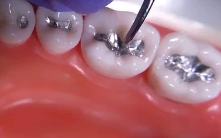 Why tooth fillings will become more expensive