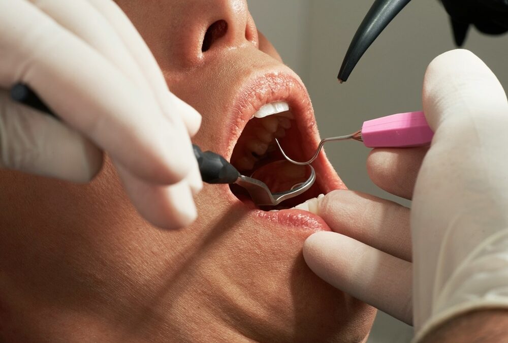 Singapore dentists to cut back on mercury fillings but retain use in selected cases as WHO urges phase‑out by 2034