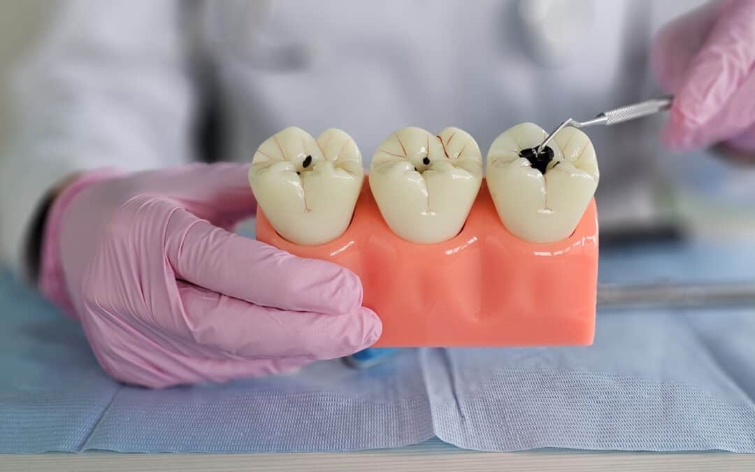 A person holds a dental model with three teeth, one showing a cavity, next to dental tools on a blue surface.