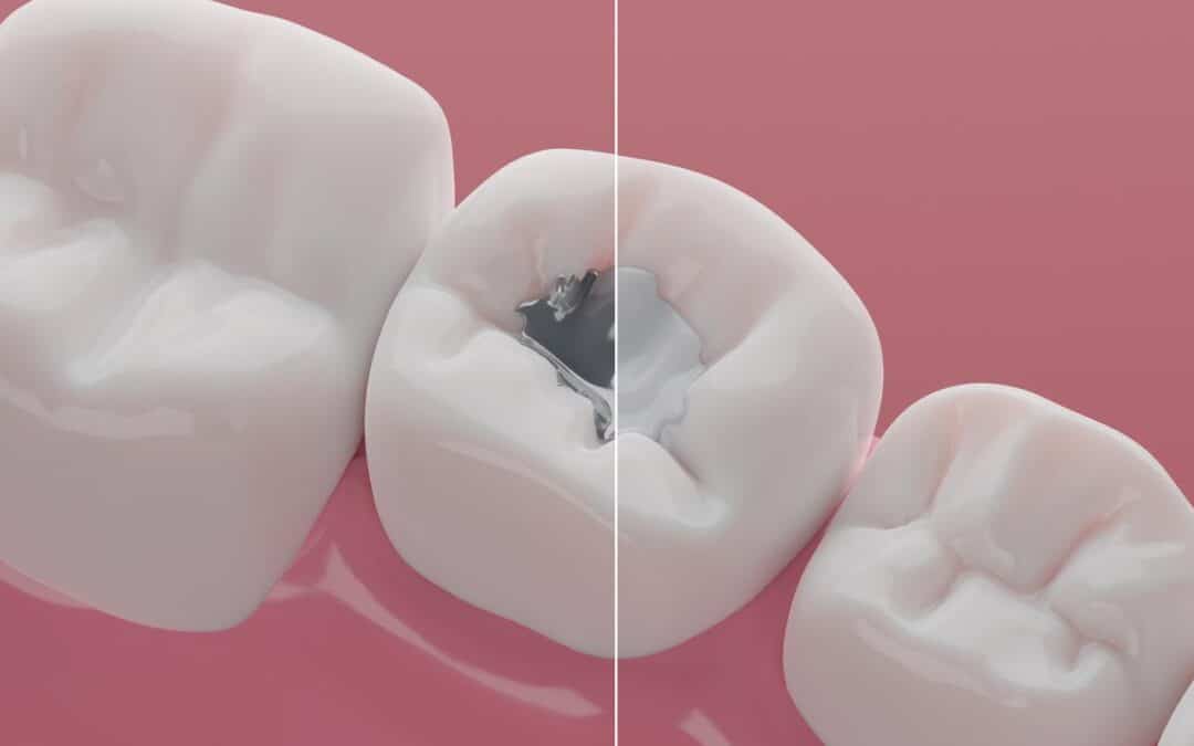 Mercury-based tooth fillings to be banned worldwide by 2034